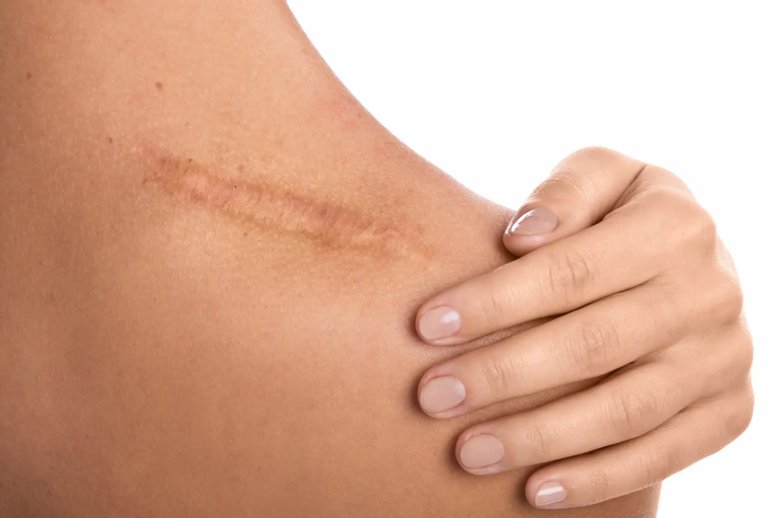 medical dermatology woman woman-with-scar-her-shoulder